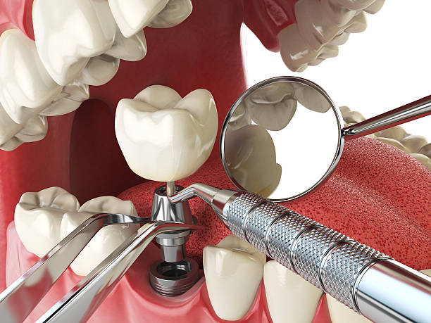 Best Lost Filling or Crown Replacement in Imperial Beach, CA